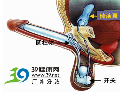 专家:<em>阴茎</em>假体植入,至少4W元-<em>阴茎</em>-<em>女性</em>