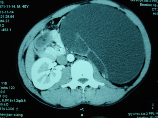 疑是"腹部巨大血肿"原是巨大肾积水作怪