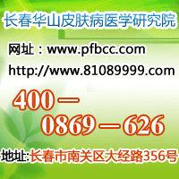 长春过敏性皮炎能根治吗?长春好的皮肤病医院