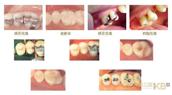 全国镶牙统一价格表