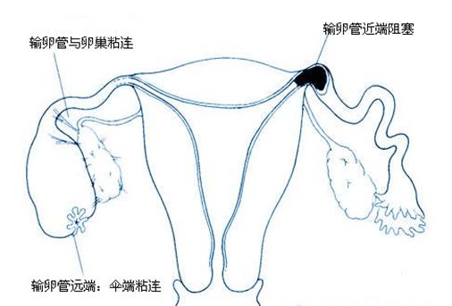 <em>输卵管堵塞</em>的<em>症状</em>是<em>什么</em> --每日甘肃-体育