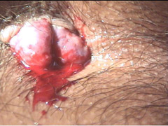 <em>大便出血</em>是<em>怎么回事</em>|乌鲁木齐天佑肛肠医院--每