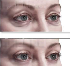 用什么可以去眼袋皱纹 11370643_969231.jpg