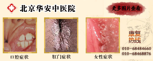 男性生殖器<em>疱疹有哪些症状</em>--每日甘肃-体育