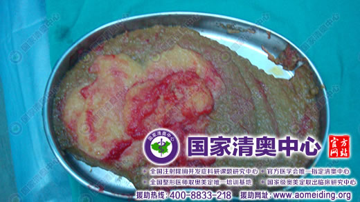 奥美定取出