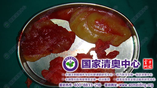 奥美定取出