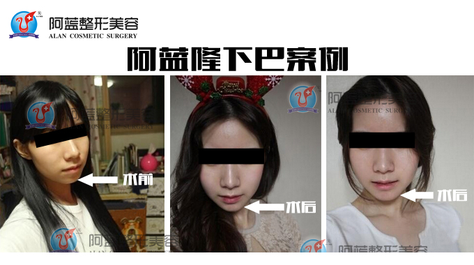 隆下巴