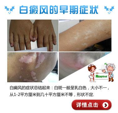 白癜风早期能治愈吗--每日甘肃-专稿
