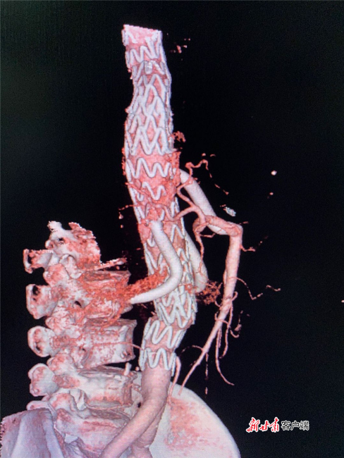 文卫 经血液外科医生分析病情,为患者制订了胸腹主动脉覆膜支架腔内